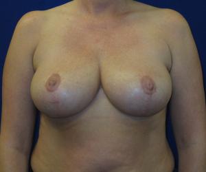 Breast Reduction- After