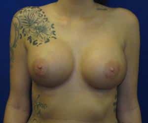 Breast Augmentation - After
