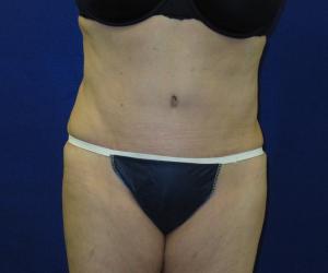 Case--7112 | After Tummy Tuck