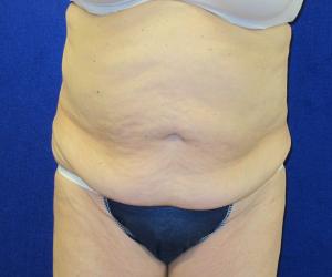 Case--7112 | Before Tummy Tuck