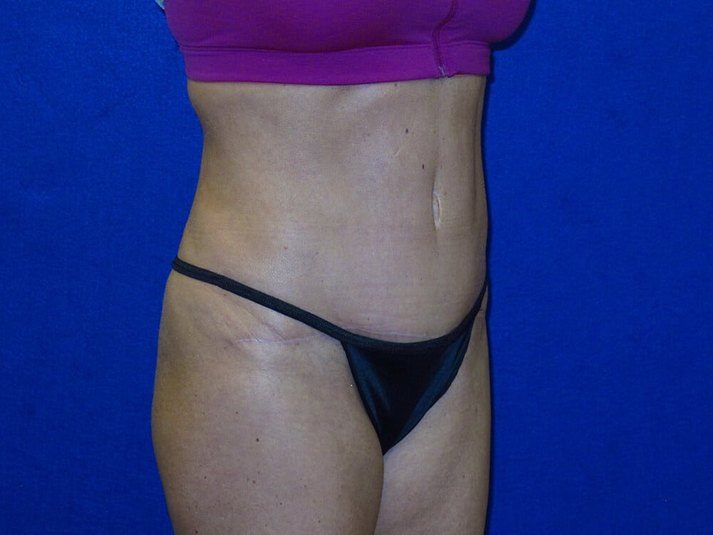Case--4871 | After Tummy Tuck