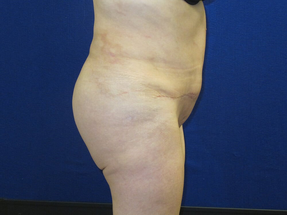 Case--4989 | After Brazilian Buttock Lift