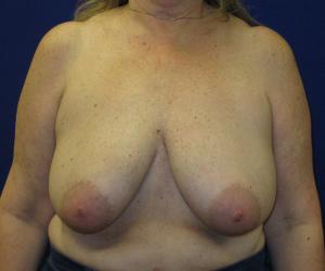 Breast Reduction - Before