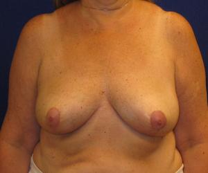 Breast Reduction- After