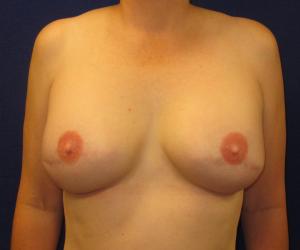 Breast Reconstruction- After