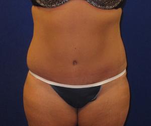 Case--9596 | After Tummy Tuck