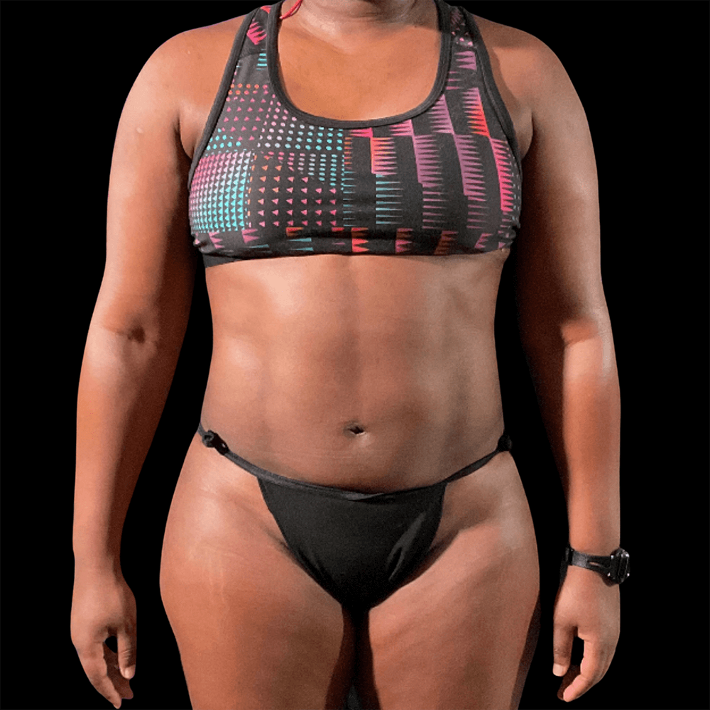 Case--4967 | After High Definition Liposuction