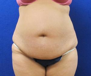 Case--9596 | Before Tummy Tuck