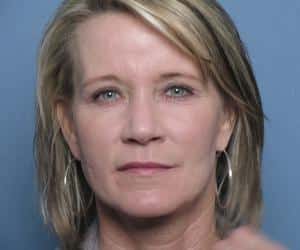 Case--7970 | After CO2 Laser Peel