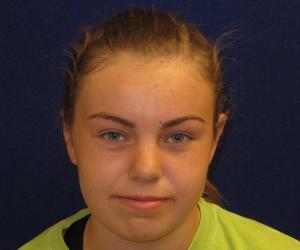 Case--7897 | After Otoplasty