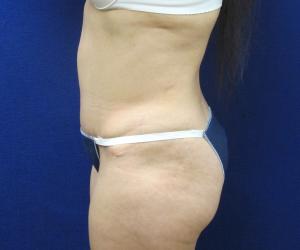 Case--3963 | After Tummy Tuck