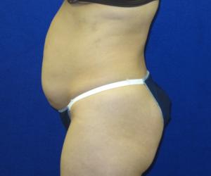 Case--3963 | Before Tummy Tuck