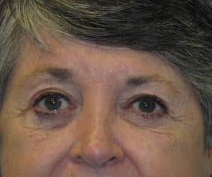 Case--3490 | After Brow Lift