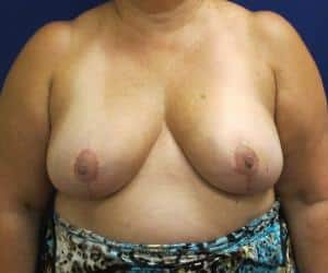 Breast Reduction- After