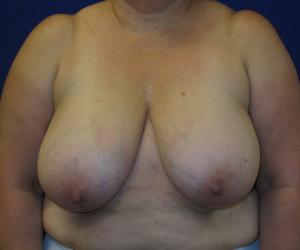 Breast Reduction - Before
