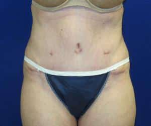 Case--7092 | After Tummy Tuck