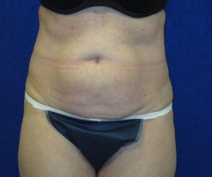 Case--7092 | Before Tummy Tuck