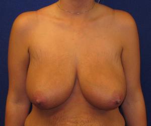 Breast Reduction - Before