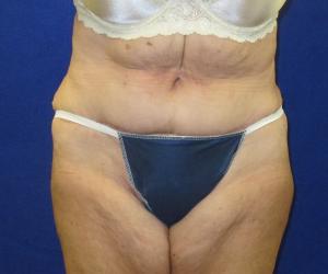 Case--1699 | After Tummy Tuck
