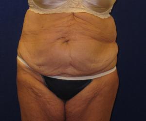 Case--1699 | Before Tummy Tuck