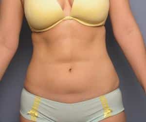 Case--4185 | Before Liposuction