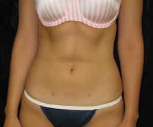 Case--4185 | After Liposuction