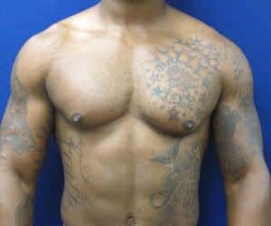 Male Breast Reduction - Before