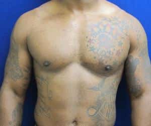 Male Breast Reduction - After