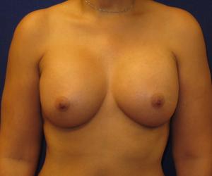 Breast Augmentation - After