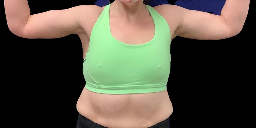 Case--1351 | After Arm Lift