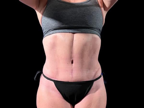 Case--2281 | After Body