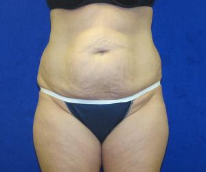 Case--7691 | Before Tummy Tuck